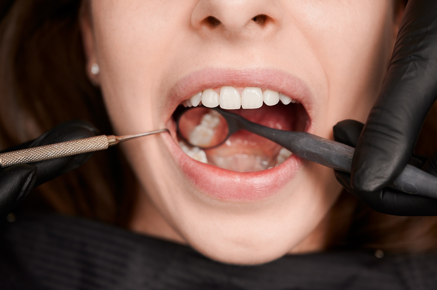 Beyond the Pull: Unexpected Ways Tooth Extraction Can Improve Your Oral Ecosystem in Somerville