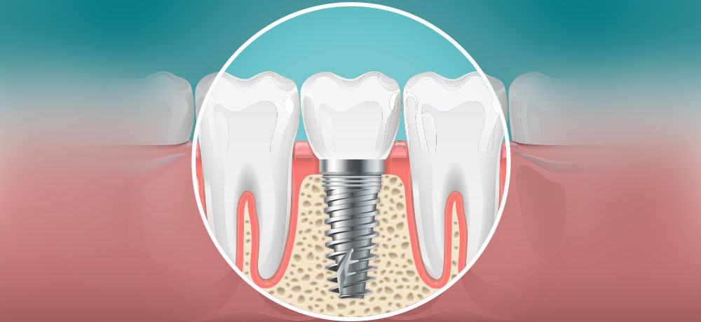 More on Dental Implants